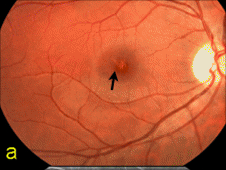 Laser Damaged Retina
