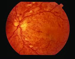 severe diabetic retinopathy